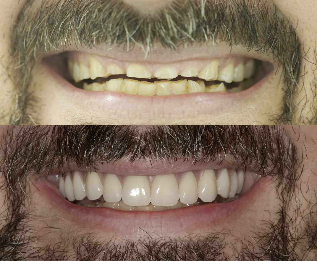 Allon4 Dental Implants Creative Smiles