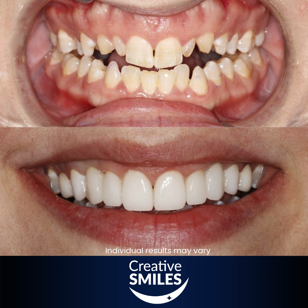 Veneers Armadale