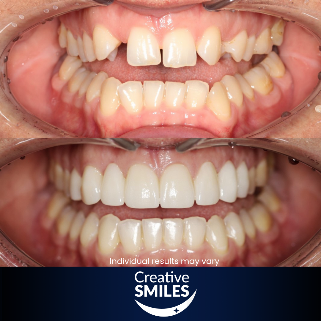 Veneers Armadale