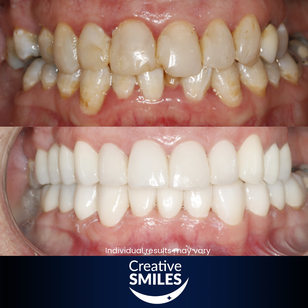 Veneers Armadale