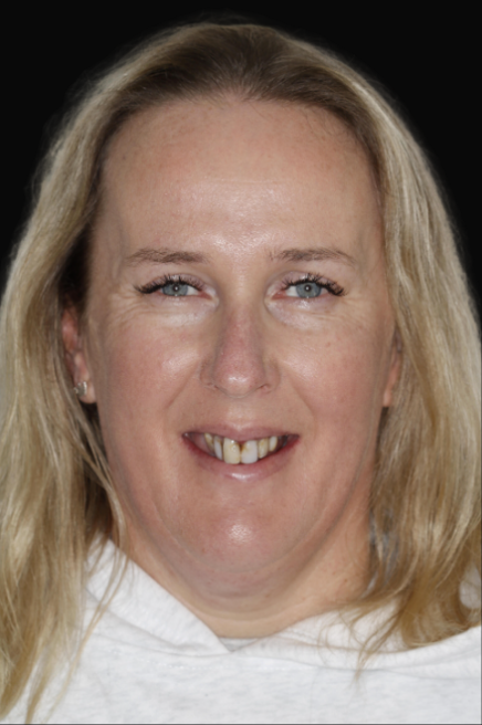 All-On-4 Dr Reza Zamani DEN0001048905 (2)