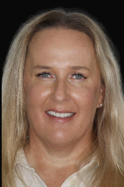 All-On-4 Dr Reza Zamani DEN0001048905 (2)