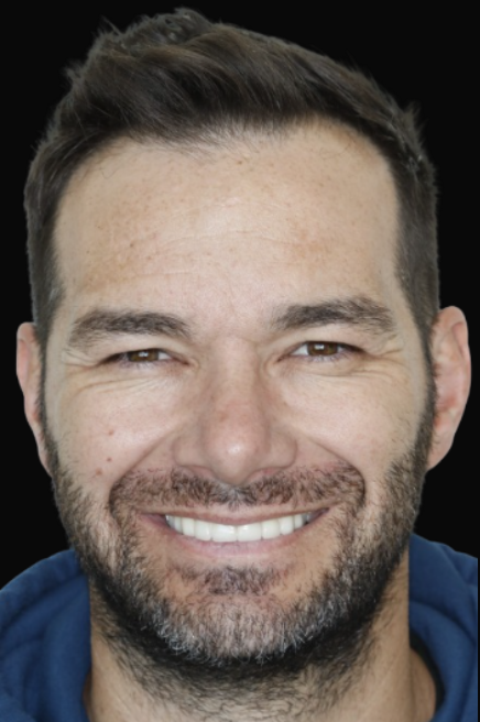 Veneers Melbourne Dr Reg