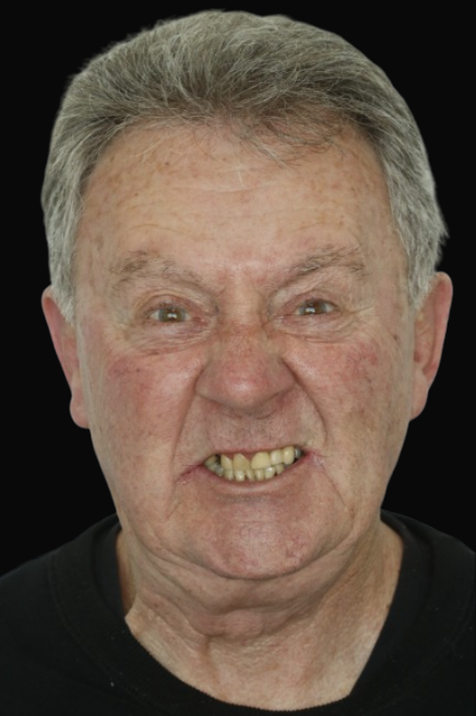 Dental Implants Melbourne Dental Bridge Melbourne Dr Reg