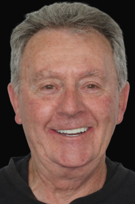 Dental Implants Melbourne Dental Bridge Melbourne Dr Reg