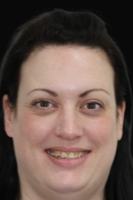 Dental Crowns Melbourne