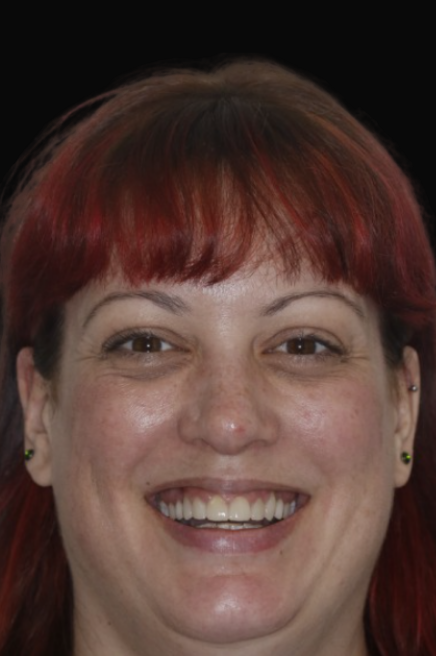 Dental Crowns Melbourne