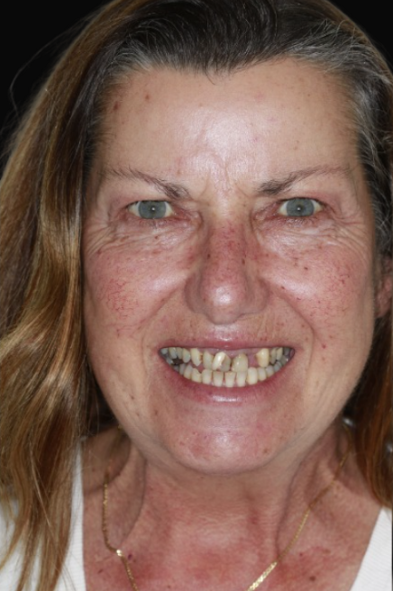 Dental crowns Melbourne Dental Bridge Melbourne