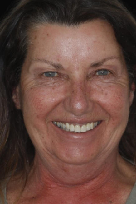 Dental crowns Melbourne Dental Bridge Melbourne