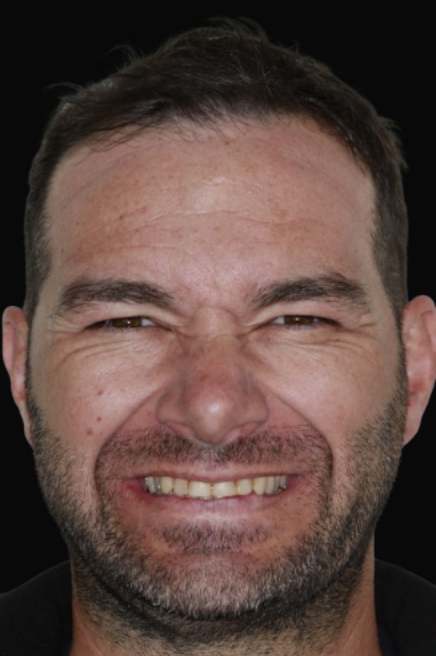 Veneers Melbourne Dr Reg