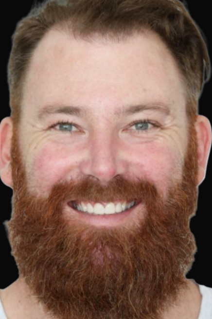 Veneers Melbourne Dr Claudia