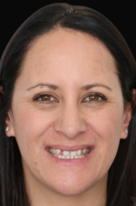 Melbourne Invisalign, crowns, veneers and bridges Dr Claudia