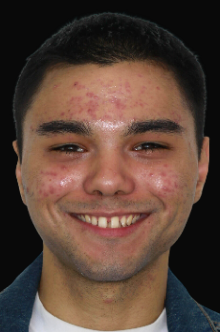 Invisalign Dr Reg De Sousa DEN0001013154