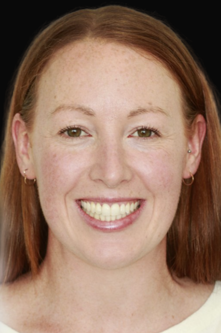 Invisalign Melbourne