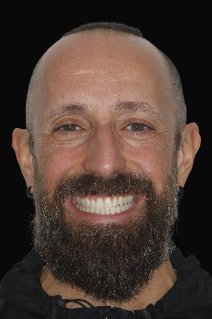 Invisalign & Composite Bonding Dr Abella Huynh DEN0002079456 (1)