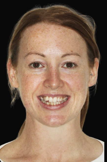 Invisalign Melbourne