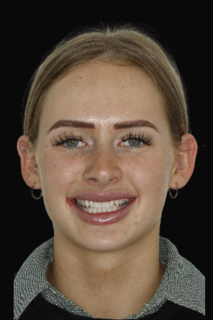 Porcelain Veneers Dr Reg De Sousa DEN0001013154 (3)