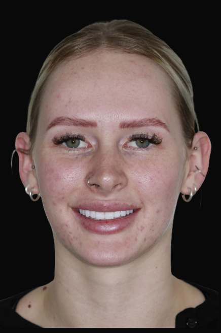 Porcelain Veneers Dr Reg De Sousa DEN0001013154 (4)