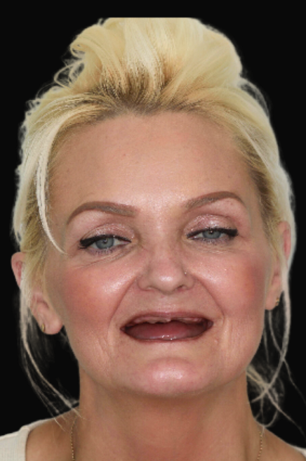 Upper & Lower Overdenture Dr Reg De Sousa - DEN0001013154