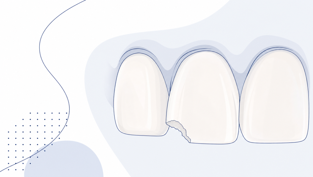 A fractured back tooth is shown with an onlay and crown nearby, illustrating restorative options after a chip.