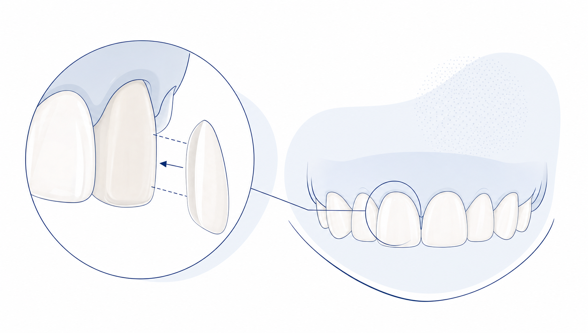 A refined editorial illustration of several thin porcelain veneer shells arranged beside a simplified prepared tooth outline, with subtle planning lines and layered material forms suggesting a veneer treatment quote or plan. The composition should feel calm, precise and spacious, with plenty of white space and no text. Style block: flat/semi-flat editorial vector, fine navy linework, restrained white and pale blue-grey palette with warm porcelain accents, minimal shadows, clean anatomical simplification, avoid glossy rendering, busy clinic details, exaggerated smiles, or any text/logo elements.