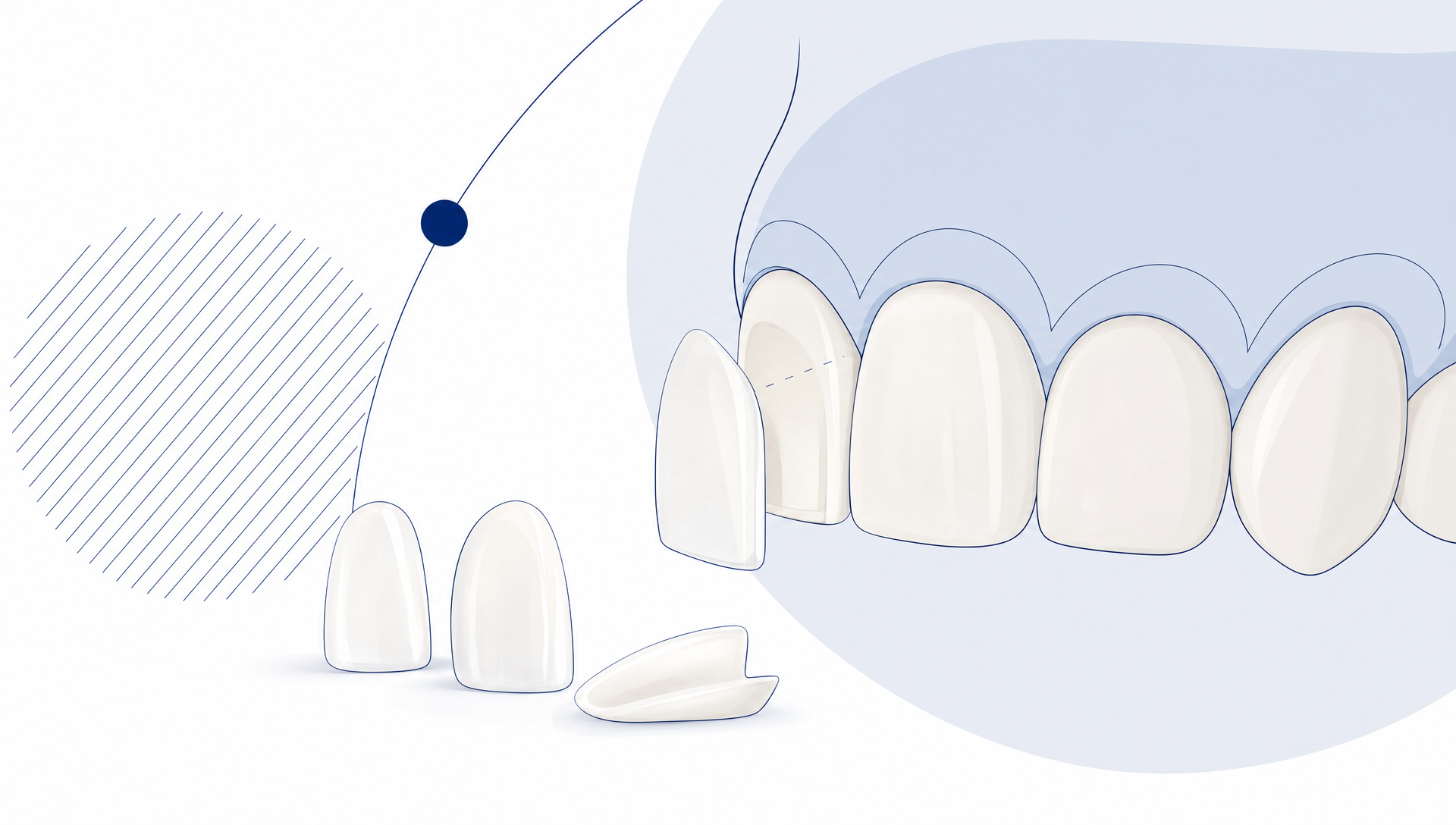 Thin porcelain veneers are arranged beside natural front teeth to show a calm planning concept for whiter teeth.